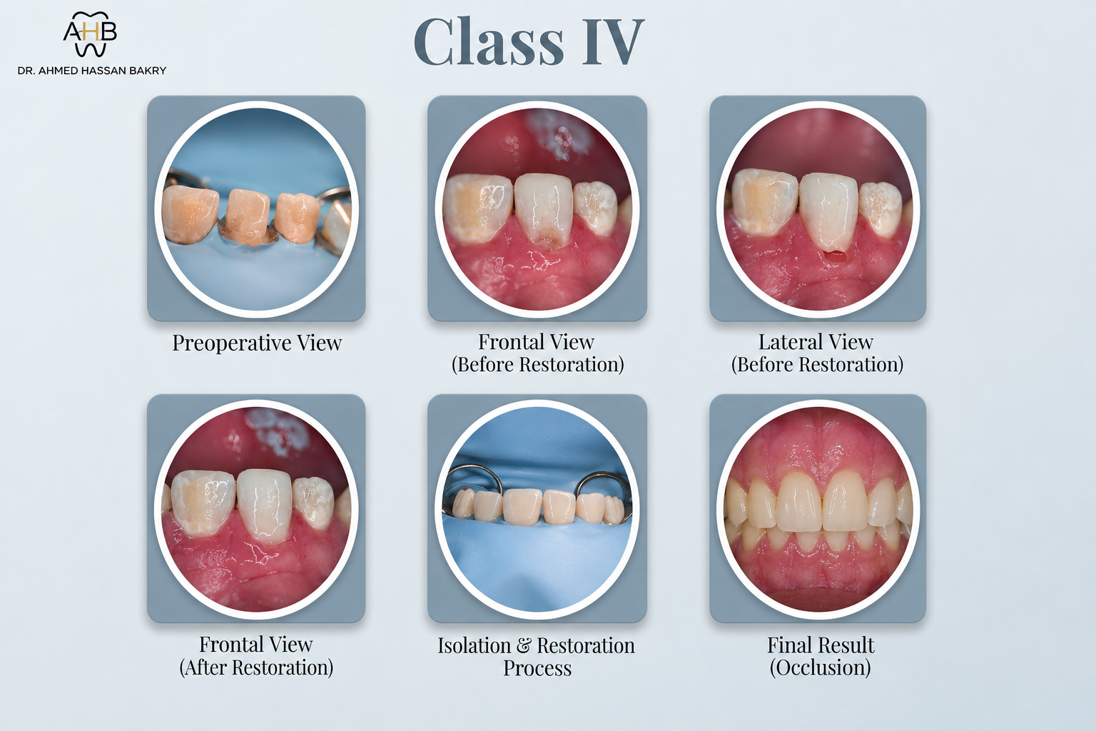 Class IV
